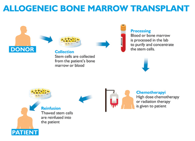 First Allogenic Stem Cell/Bone Marrow transplant for Thalassemia