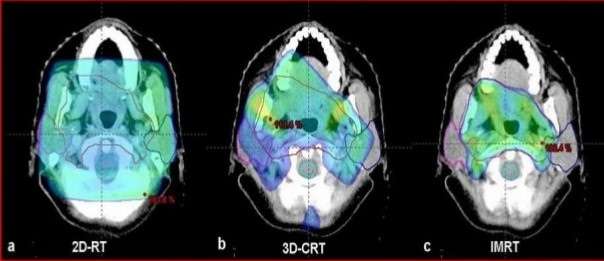 3Dimensional-Conformal-Radiation-Therapy