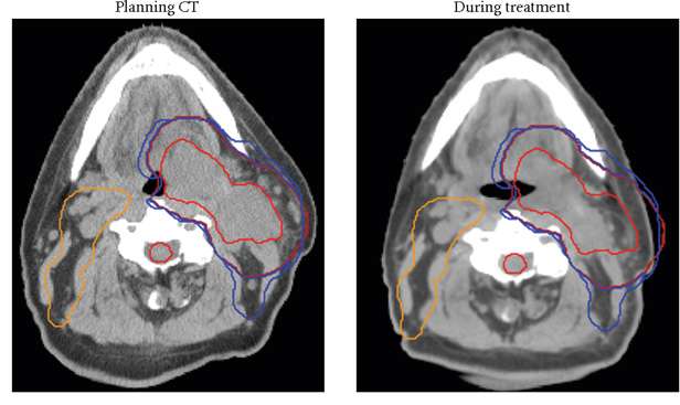 Adaptive-Radiotherapy hospital in visakhapatnam
