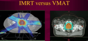 IMRT VS VMAT