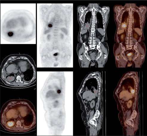 PET-based-Radiotherapy-Planning