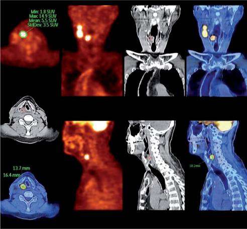 PET-based-Radiotherapy-Planning visakhapatnam