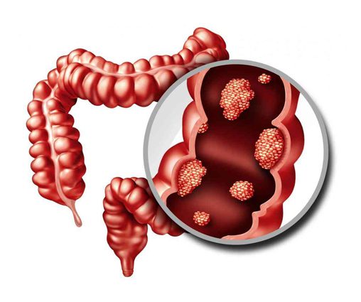 Colorectal Cancer robotic surgery treatment in vizag