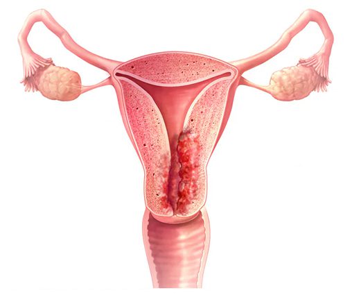 Endometrial cancer hospital in Visakhapatnam