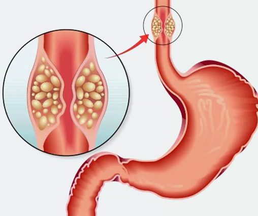 Esophagectomy treatment center in vizag