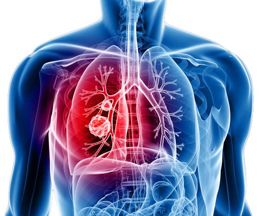 Lung Cancer treatment vizag