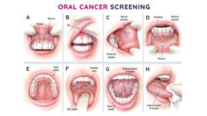 Oral Cancer is the sixth most common type of cancer worldwide. In India, Oral Cancer ranks among the top three types of cancer accounting for 30% of all cancers reported.