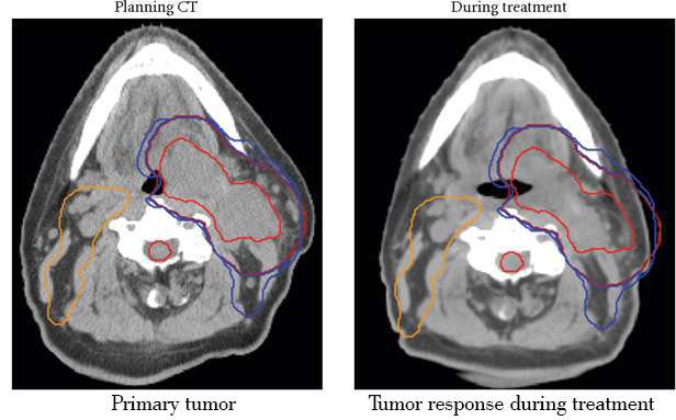 Adaptive-Radiotherapy (1)