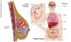 what is breast cancer types