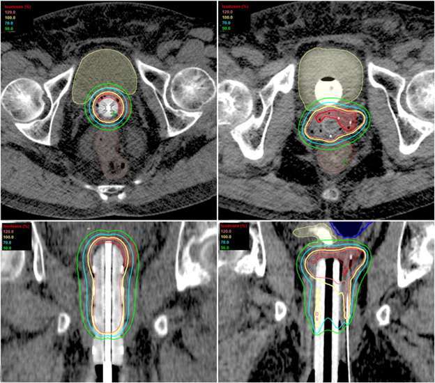 Image-Guided-Brachytherapy