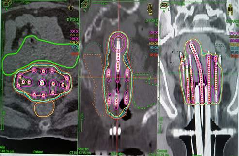 Interstitial Brachytherapy in cervix