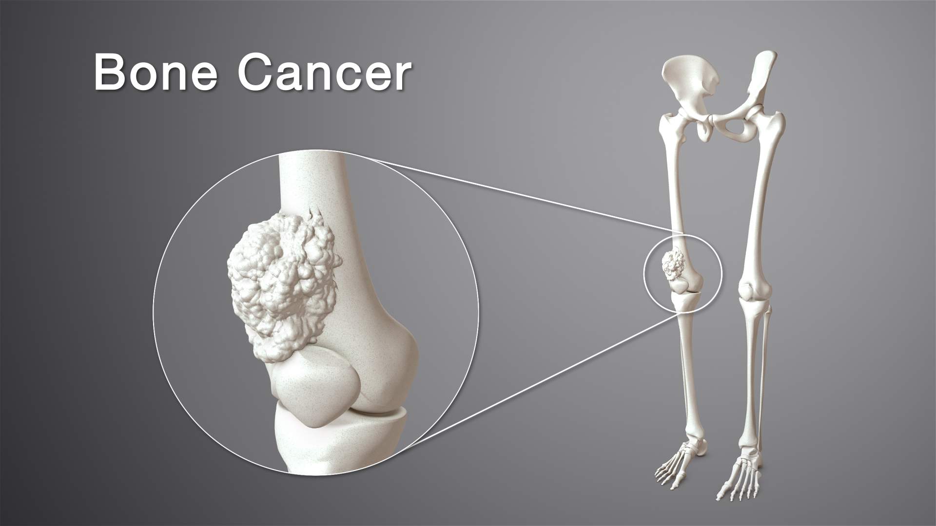Exploring Bone Cancer: A Comprehensive Guide